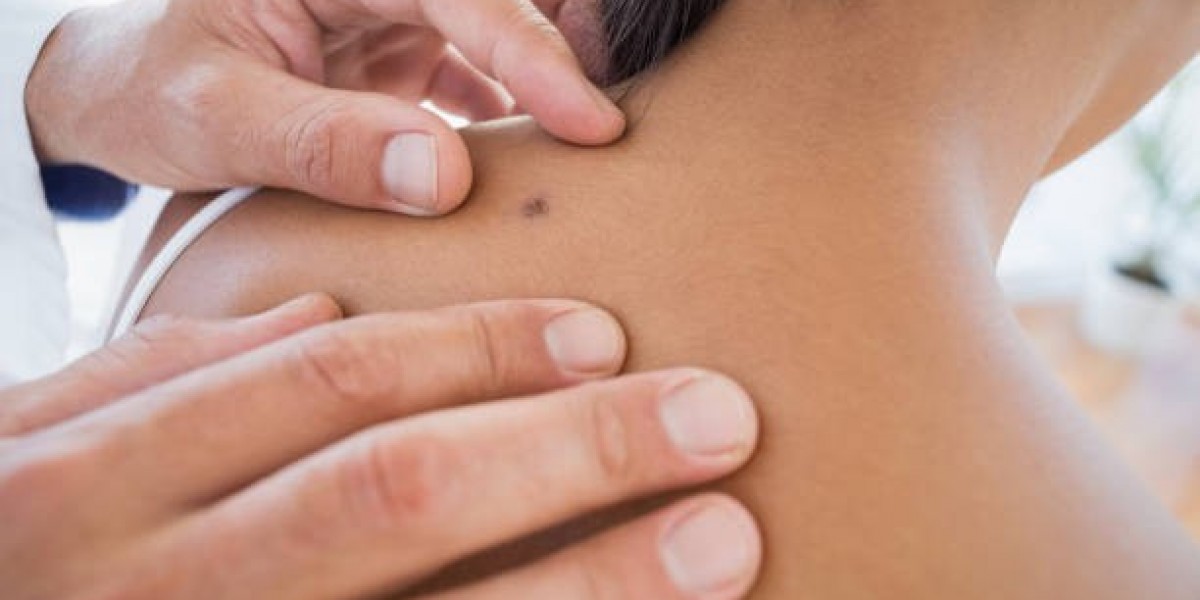 Skin Tag Removal Tips for All Skin Types