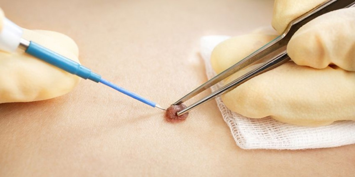 Smooth Skin Starts with Skin Tag Removal Treatment