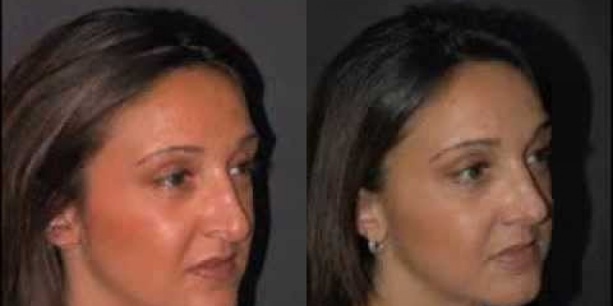 ترند تجميل الأنف: شاهد أفضل التحولات الجمالية قبل وبعد